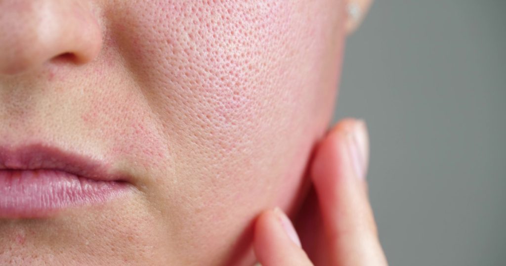 Macro skin with enlarged pores. Allergic reaction, peeling, care for problem skin.
